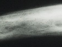 Potential breast cancer prevention drug found to cause significant bone loss