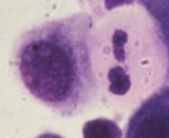 Traitorous immune cells promote sudden ovarian cancer progression