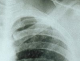 Declines in smoking and lung cancer mortality in the U.S.