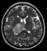 Dual immune checkpoint inhibition with radiotherapy does not improve progression-free survival for patients with newly diagnosed MGMT-unmethylated glioblastoma