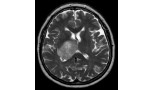Dual immune checkpoint inhibition with radiotherapy does not improve progression-free survival for patients with newly diagnosed MGMT-unmethylated glioblastoma