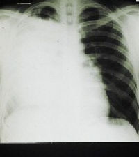 New marker discovered to aid early detection of lung damage