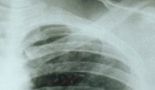 Lung cancer cases keep going up in women
