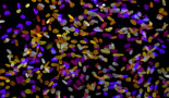 EHA 2020: Ruxolitinib, the first proven drug for treating steroid-refractory acute graft-versus-host-disease