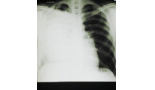 People fail to list persistent cough as a lung cancer warning