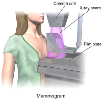 Catching more breast cancers when mammograms are limited