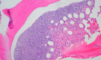 Viagra and plerixafor show promise for use in bone marrow transplants