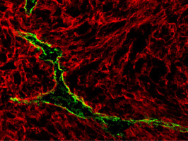 Lymphatic vessels that help cancers spread can also boost immune therapies