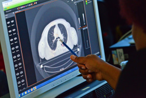 Pioneering ‘precision’ radiotherapy boosts prostate cancer survival