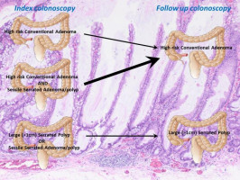 Serrated polyps plus conventional adenomas may mean higher risk for colorectal cancer
