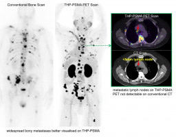 Safety and biodistribution of one-step radiopharmaceutical kit for prostate cancer imaging demonstrated