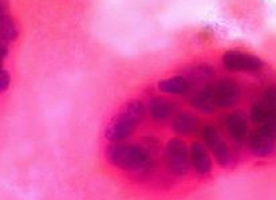 Everolimus approved by European Commission to treat patients with the most common form of advanced breast cancer