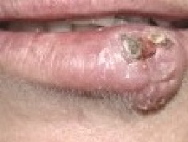 An increased risk of lip cancer with photo-sensitising antihypertensive drugs