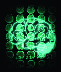 Bacterias asociadas a tumores los transportan a los puntos de metástasis