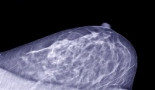 Breast cancer stem cell clues may help develop therapeutics