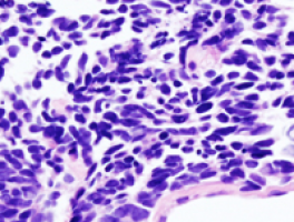 Prostate Cancer Survival Rates Improved Since Introduction of PSA Testing