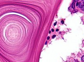 New study explains how inflammation causes gastric cancer