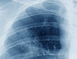 Novel therapeutic targets identified for small cell lung cancer