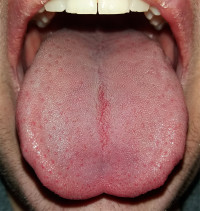 Researchers find possible markers for earlier diagnosis of aggressive tongue cancer