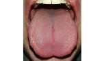 Researchers find possible markers for earlier diagnosis of aggressive tongue cancer
