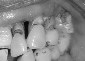Evidence mounts of link between severe gum disease and various cancers