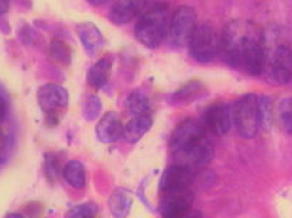 Study gives better picture of genetic causes of breast cancer