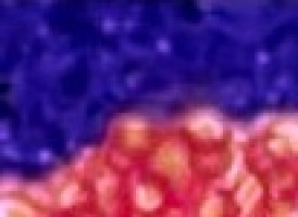 Women respond better to the treatment of lymph gland cancer with antibodies than men