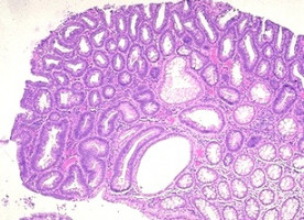 Folic acid, vitamins B6 and 12 do not affect colorectal adenoma risk