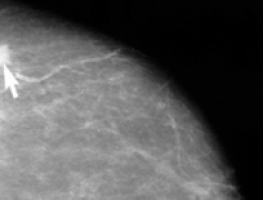 Combining imaging and gene analysis could transform breast cancer diagnosis