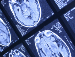 Uninsured brain cancer patients may be more likely than insured to die after surgery to remove tumour