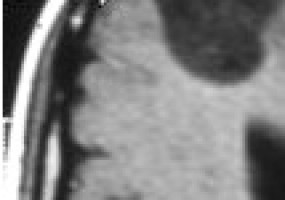 Metabolic protein launches sugar feast that nurtures brain tumours