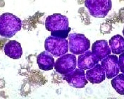 Genetic basis of immune evasion via PD-L1 pathway