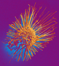 A protein that helps trap bacteria may contribute to metastasis in breast cancer