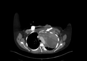 CT vs PET/CT chest scans for initial metastatic assessment of head and neck cancers