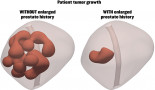 Enlarged prostate could actually be stopping tumour growth, simulations show