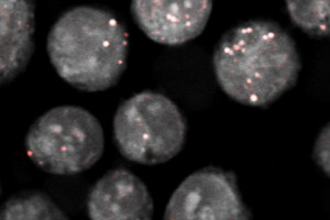 Blocking cholesterol storage could stop growth of pancreatic tumours