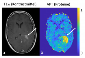 Protein content as a marker for response to therapy in brain cancer