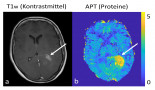 Protein content as a marker for response to therapy in brain cancer