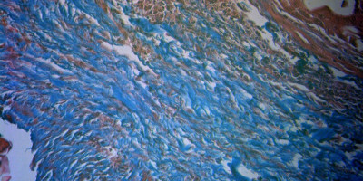 Imaging technique finds differences between radiation-sensitive and resistant tumours