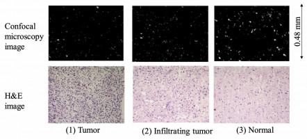 Bright spot analysis for photodynamic diagnosis of brain tumours using confocal microscopy