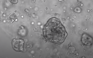 Chemotherapy for rare cancer fine-tuned with organoids