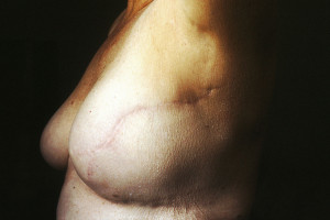 Nationwide study finds breast cancer patients unaware of surgical options