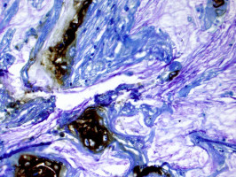 Biomarker predicts which pancreatic cysts may become cancerous