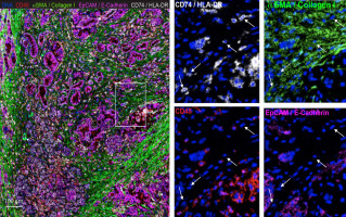 Special fibroblasts help pancreatic cancer cells evade immune detection