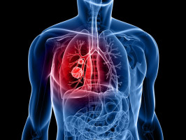 Adding immunotherapy after initial treatment can benefit metastatic lung cancer patients