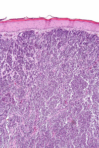 Largest genomic analysis of Merkel cell carcinoma patients completed