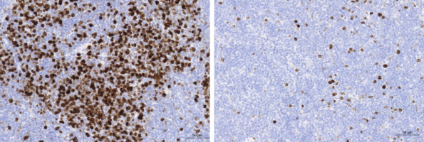 Spatial analysis finds immune-rich pockets in diffuse large B-cell lymphoma tumors with clear treatment potential
