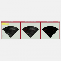 A dual imaging approach may improve diagnosis and monitoring of prostate cancer