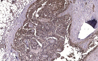 FAK protein linked to chemotherapy resistance in ovarian cancer