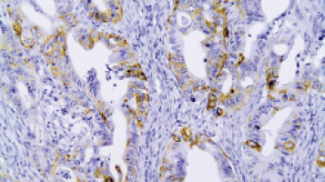 Simple tumour biomarker test predicts which stomach cancer patients will respond to immunotherapy